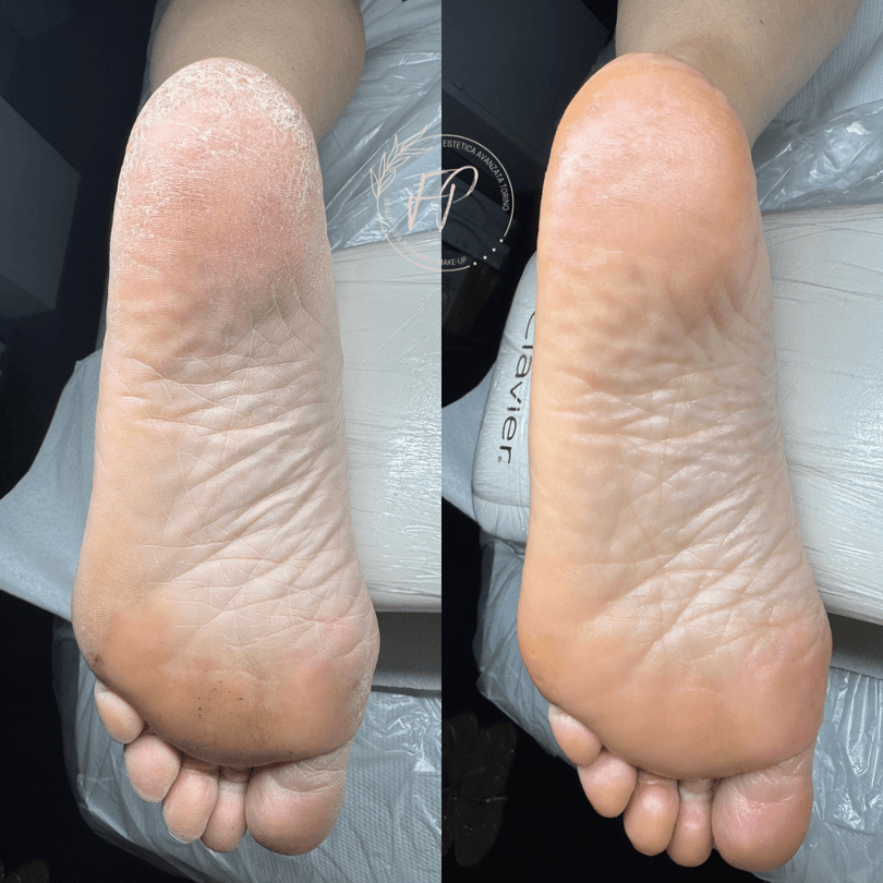 Pedicure curativa avanzata