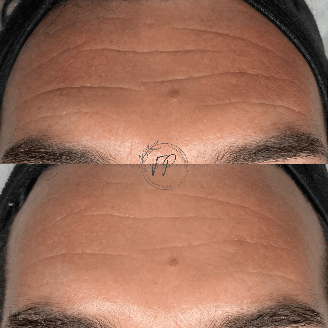 Biorivitalizzazione con fili liquidi