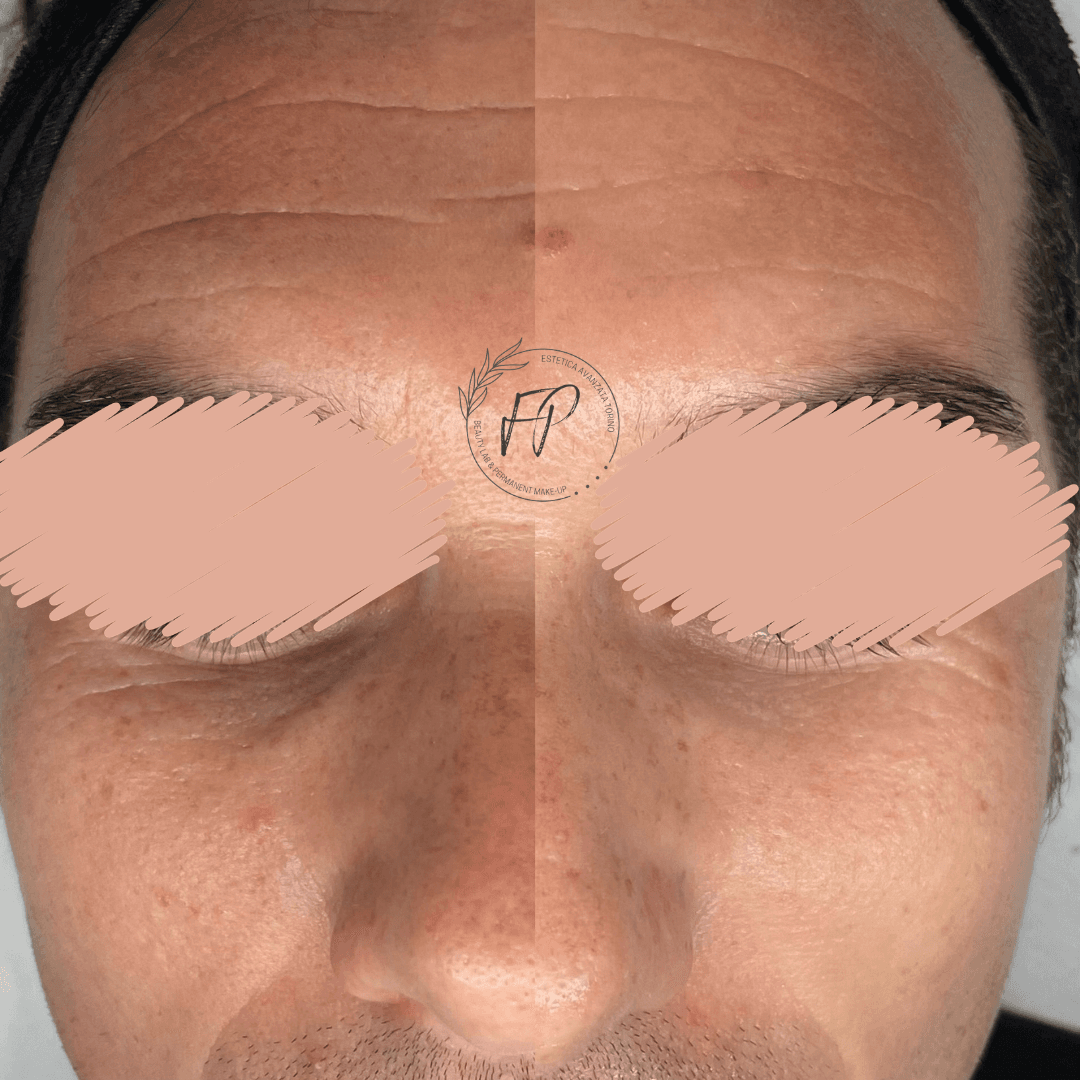 Biorivitalizzazione con fili liquidi