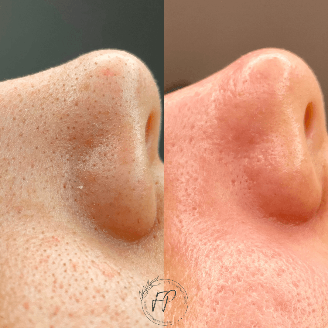 Pulizia viso Expert