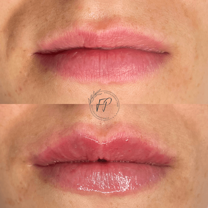 Volume Lips