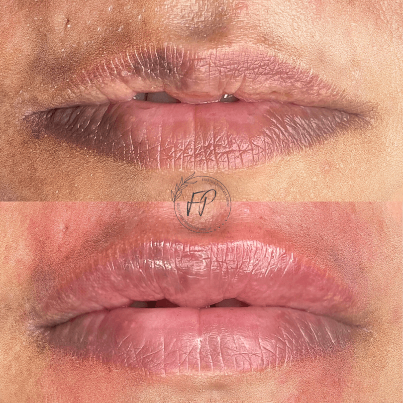 Volume Lips