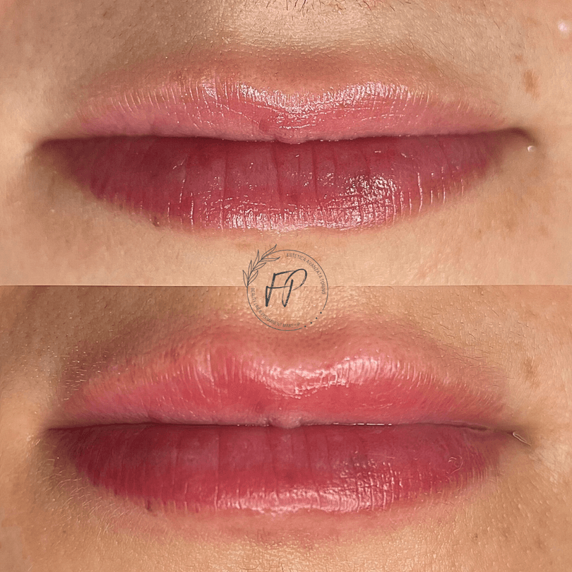 Volume Lips