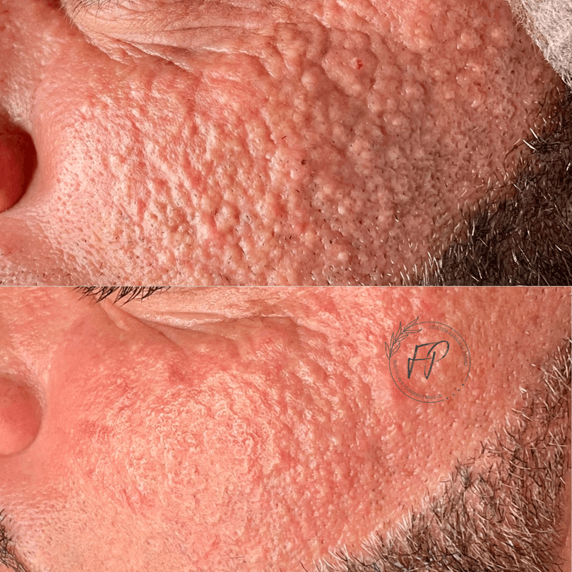 Trattamento Acne / Pelle Sensibile