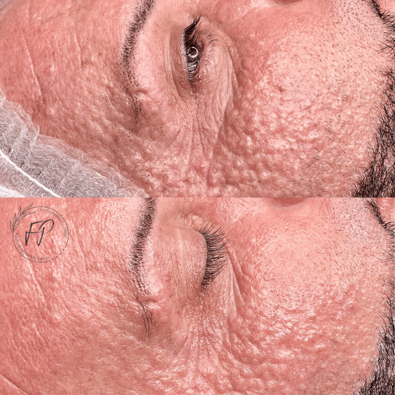 Trattamento Acne / Pelle Sensibile