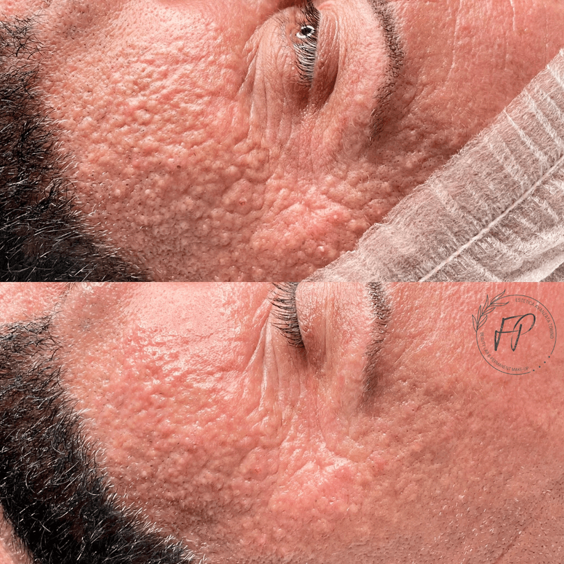 Trattamento Acne / Pelle Sensibile